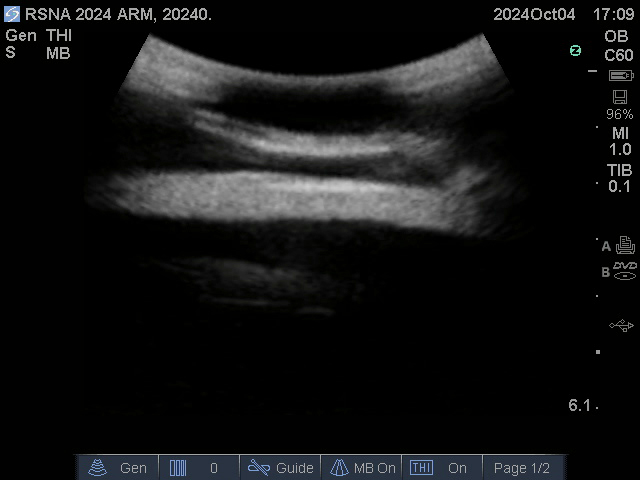 Coronal — Muscles