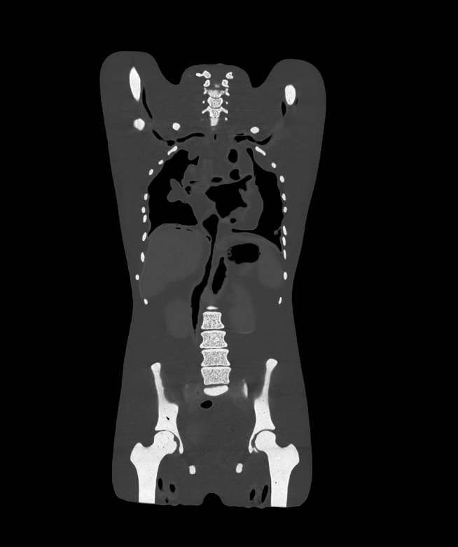 CT Scans