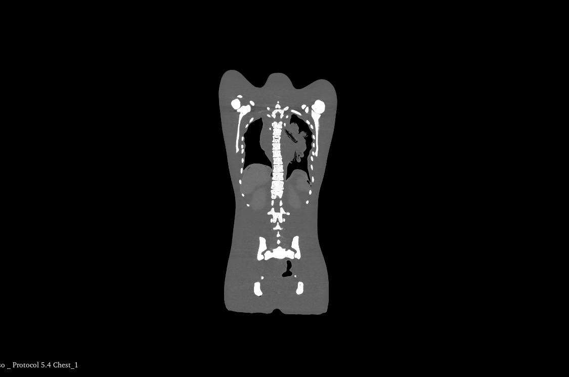 CT Scans
