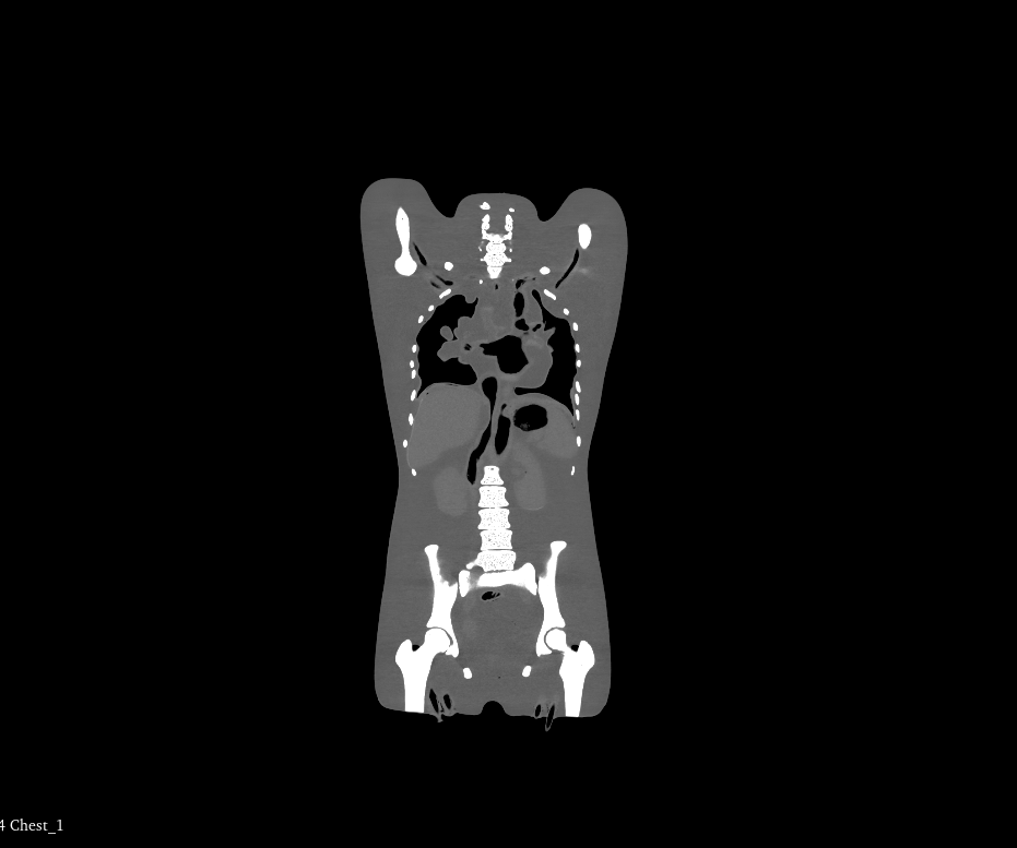 CT Scans