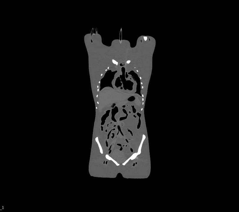 CT Scans