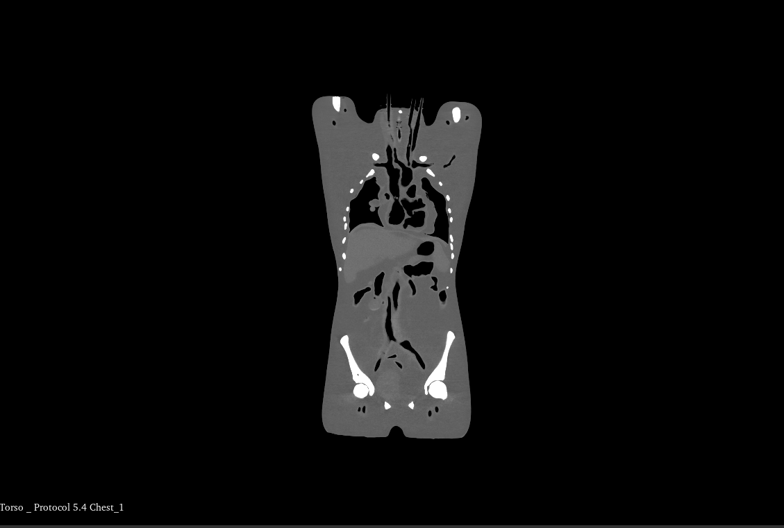 CT Scans