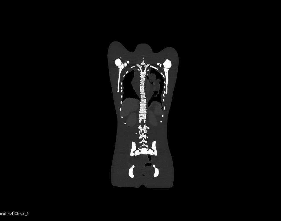 CT Scans