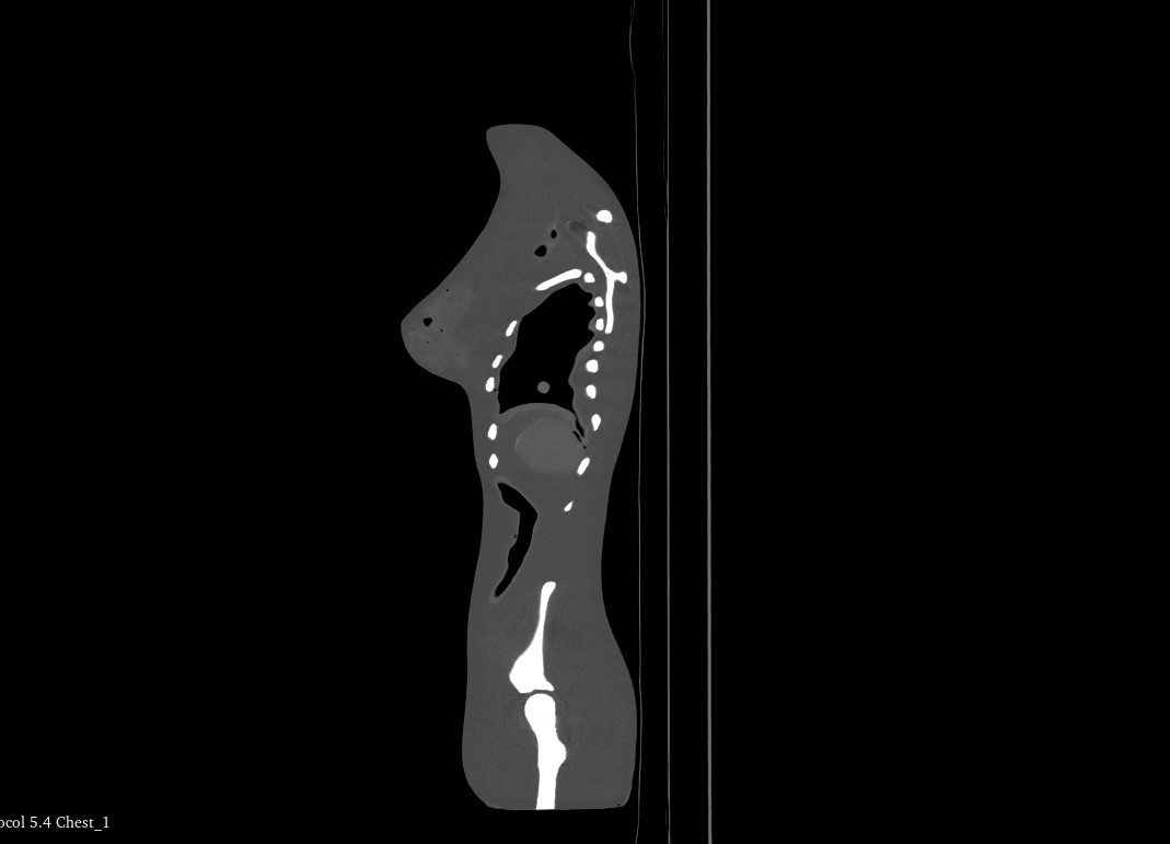 CT Scans