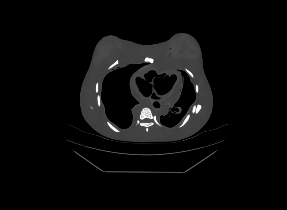 CT Scans