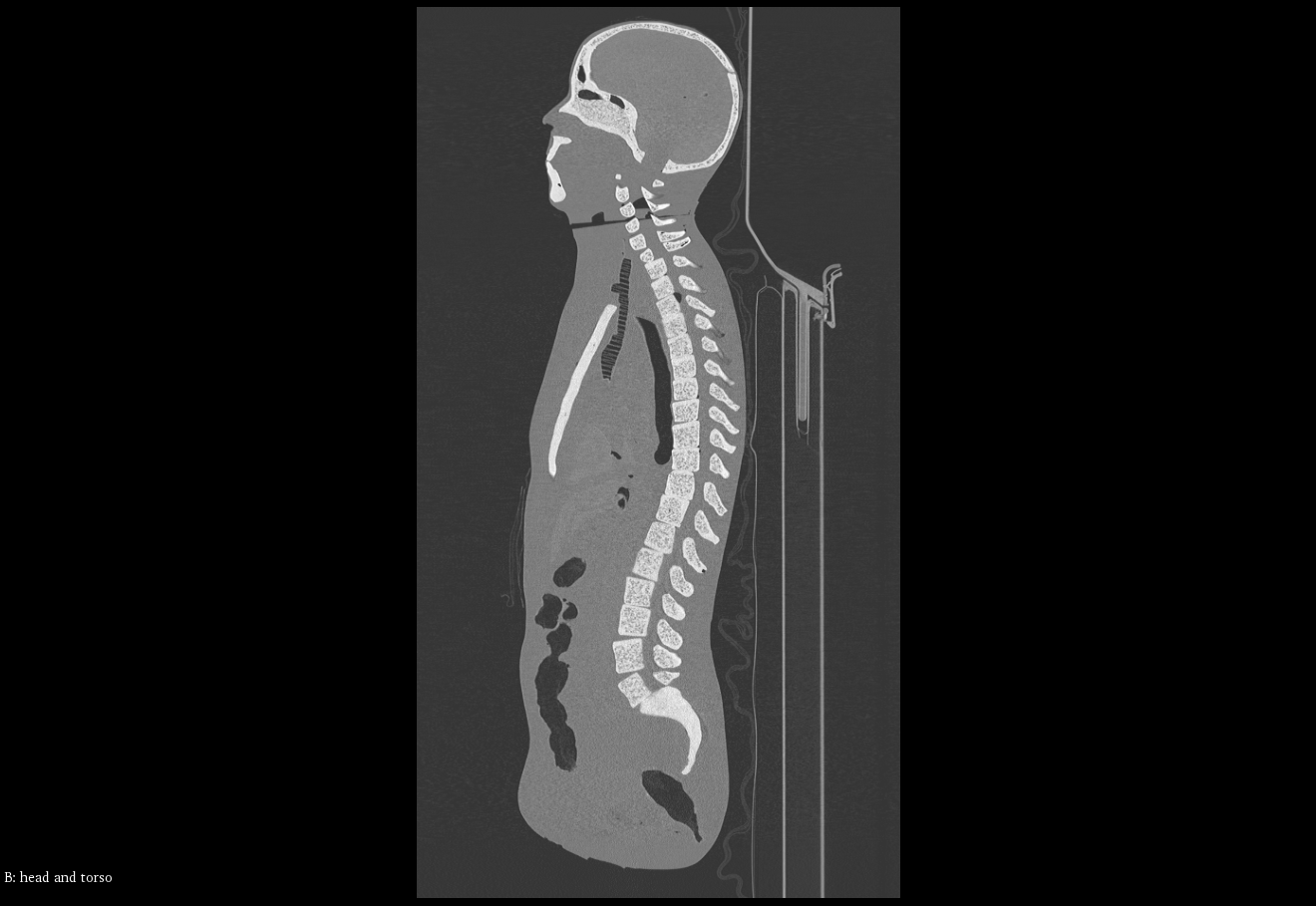 CT Scans