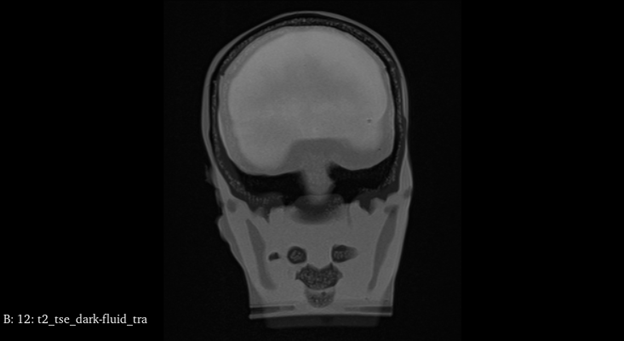 MRI Scans