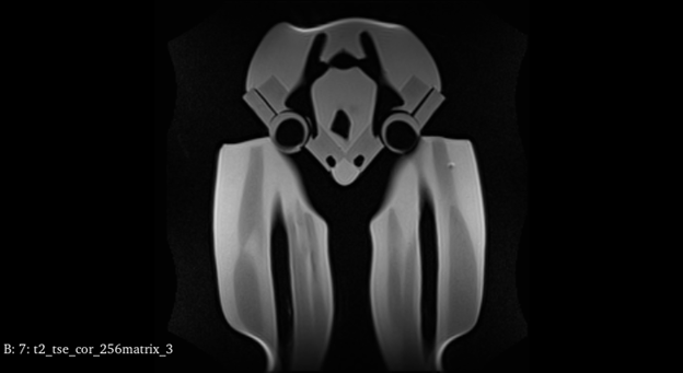 MRI Scans