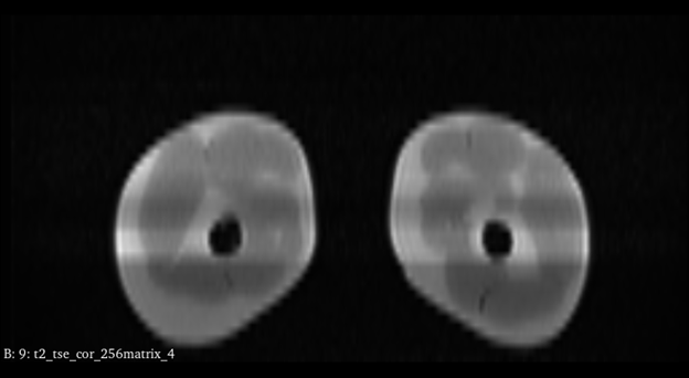 MRI Scans