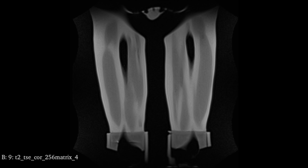 MRI Scans