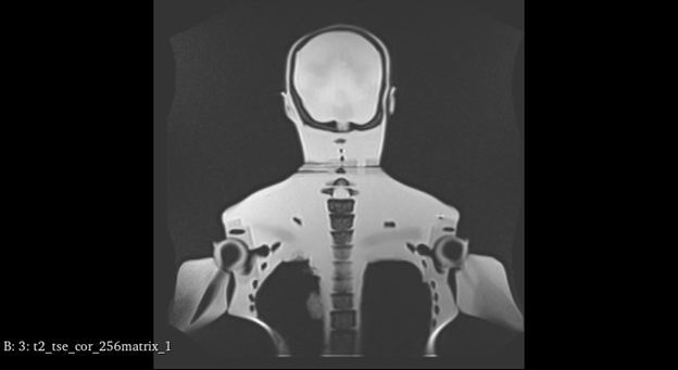 MRI Scans