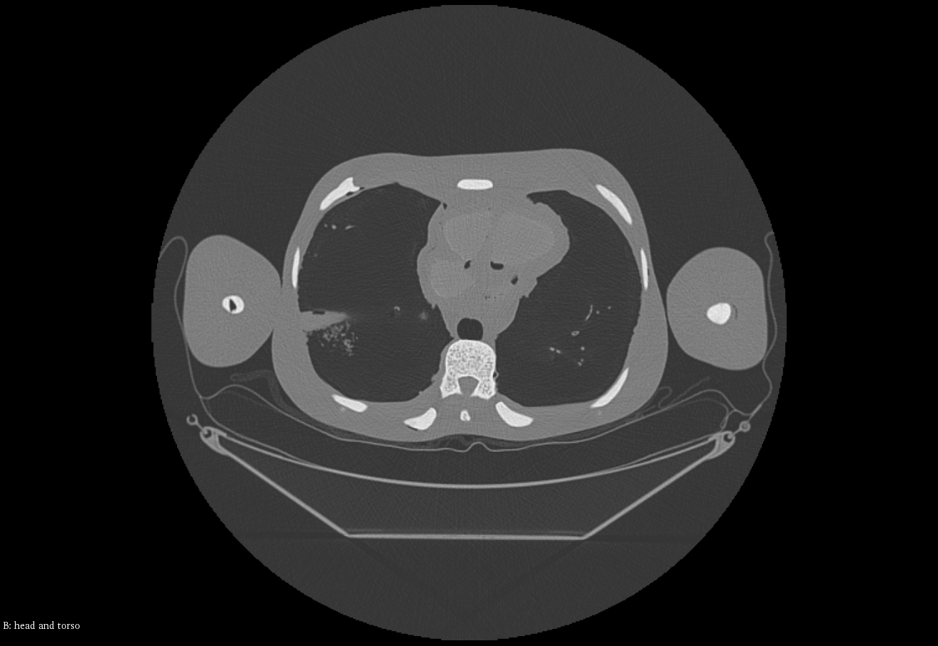 CT Scans
