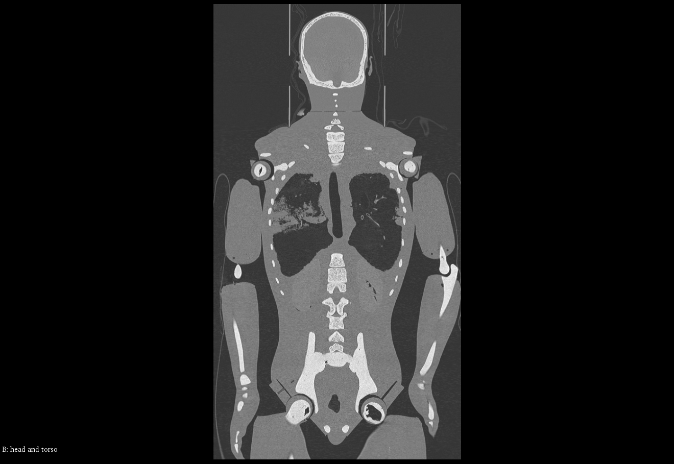 CT Scans