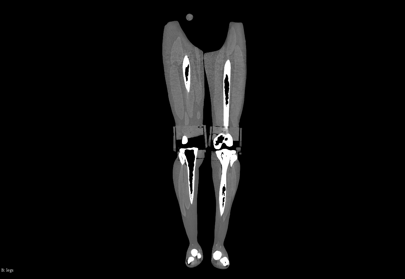 CT Scans