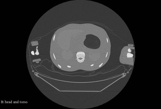 CT Scans