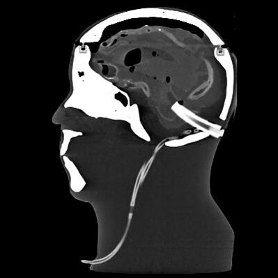 CT Scans