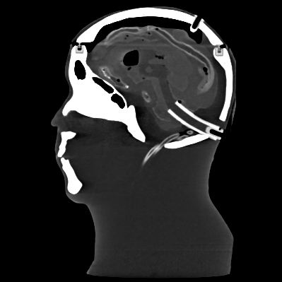 CT Scans