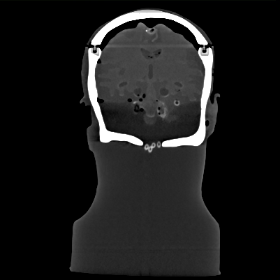 CT Scans
