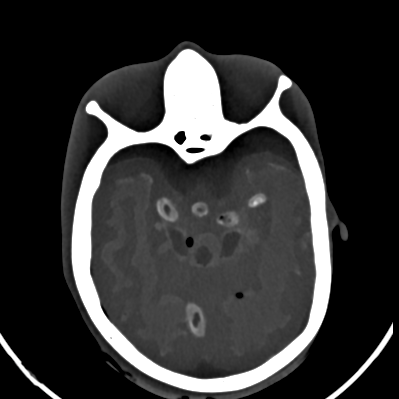 CT Scans