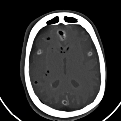CT Scans