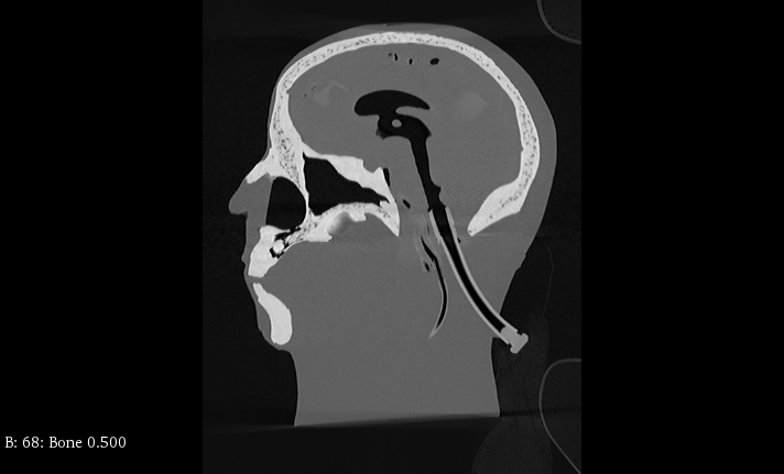 CT Scans