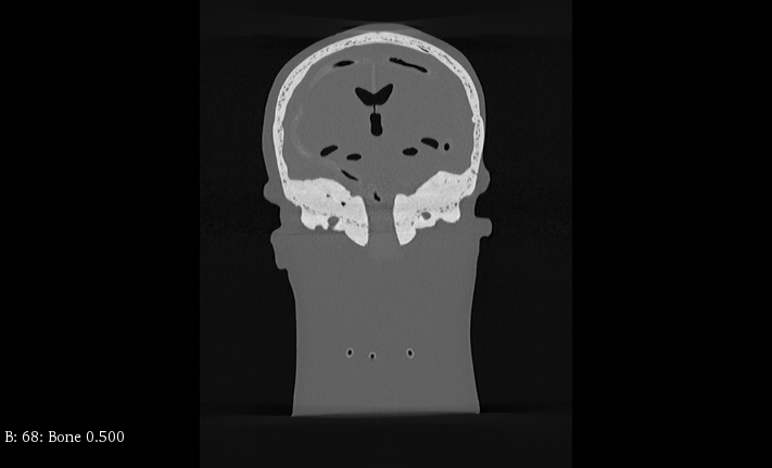CT Scans