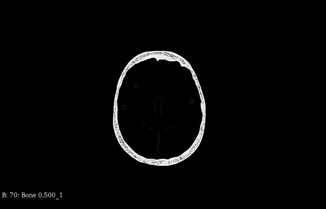 CT Scans