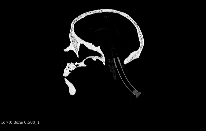 CT Scans