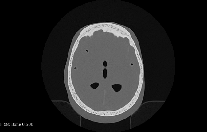 CT Scans