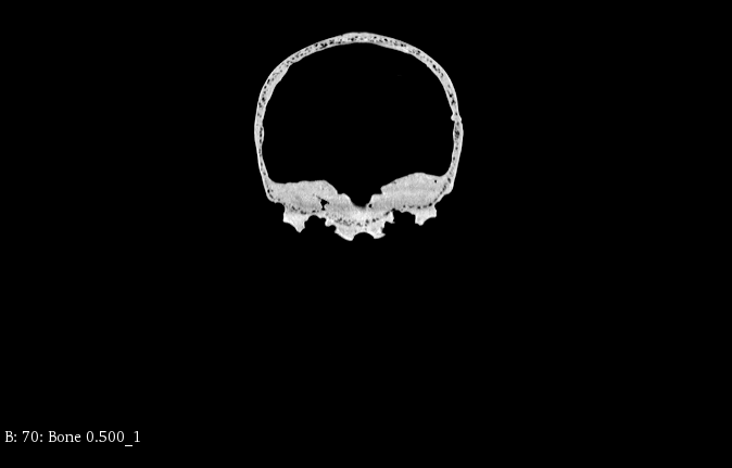 CT Scans
