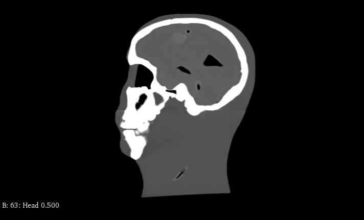 CT Scans