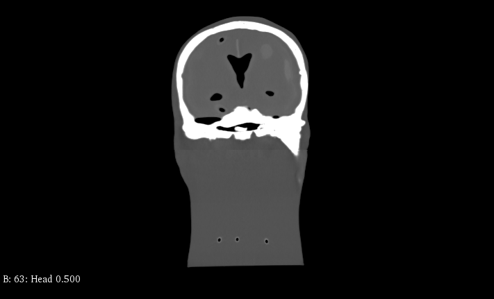 CT Scans