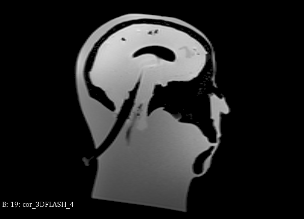 MRI Scans