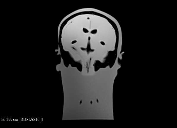 MRI Scans
