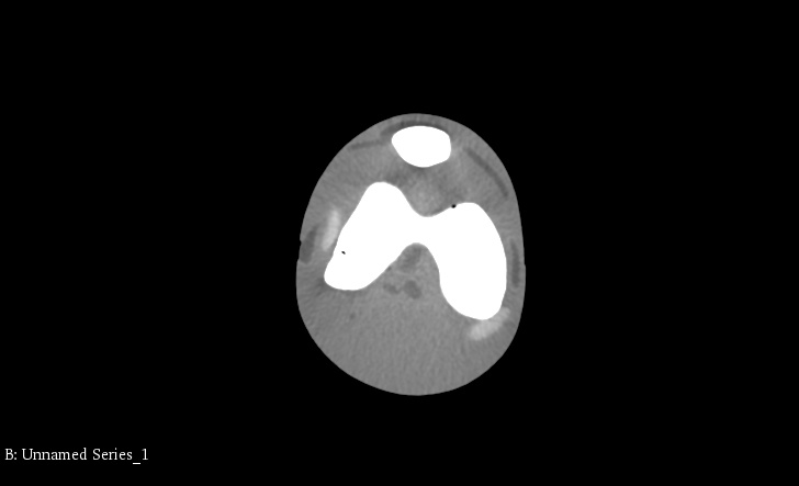 CT Scans