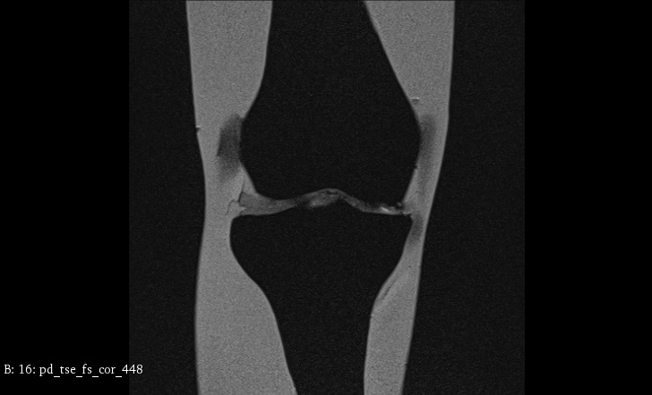 MRI Scans