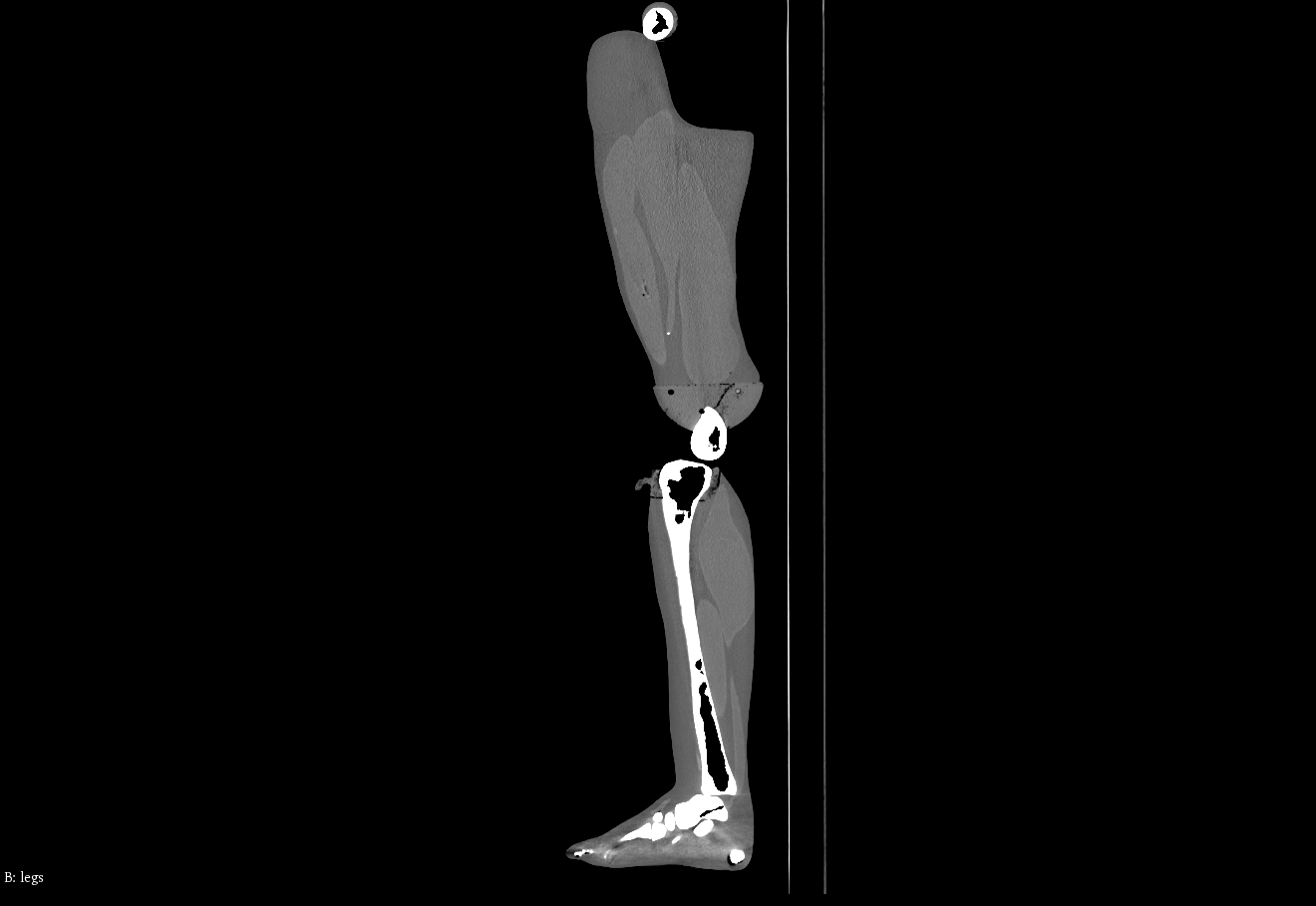 CT Scans