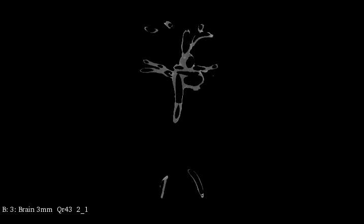 CT Scans