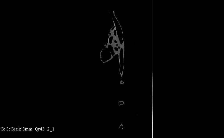 CT Scans