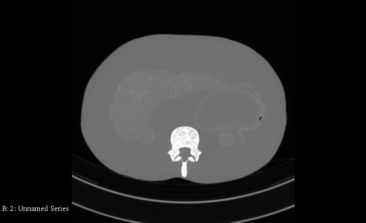 CT Scans
