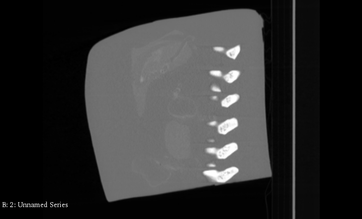 CT Scans