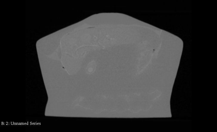 CT Scans