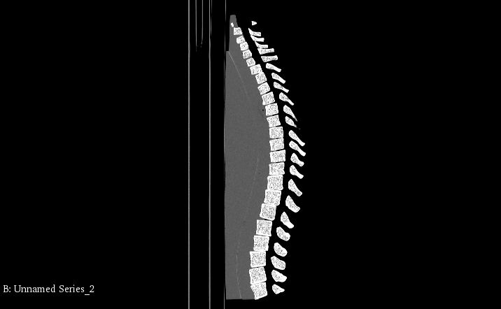 CT Scans