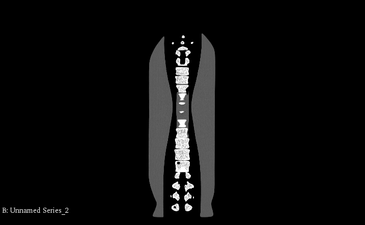 CT Scans