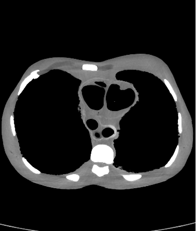 CT Scans