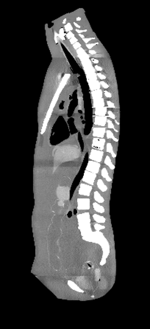 CT Scans