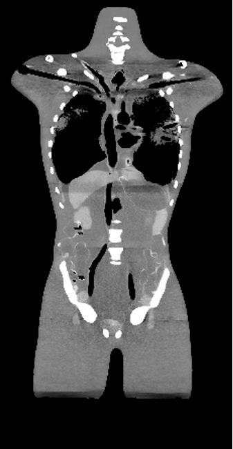 CT Scans