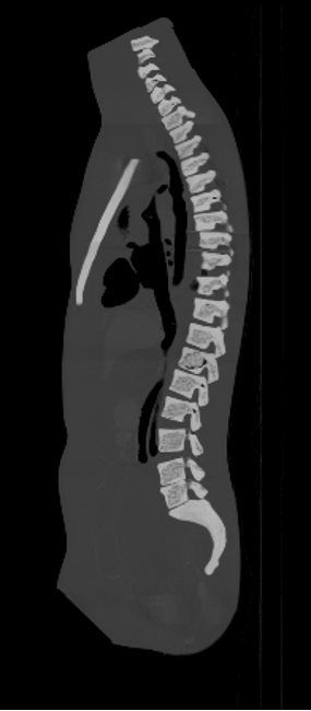CT Scans