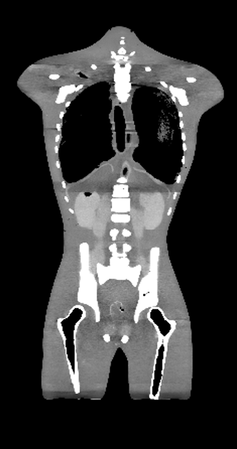 CT Scans