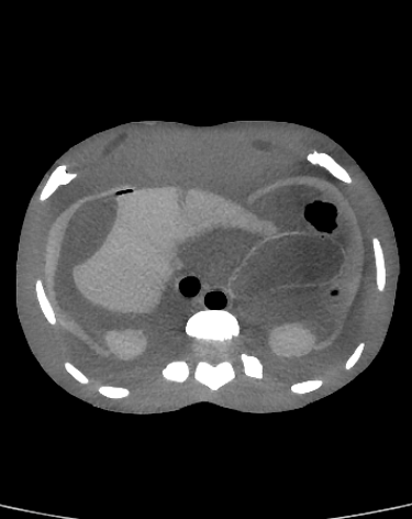 CT Scans